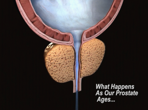 Prostate Ages